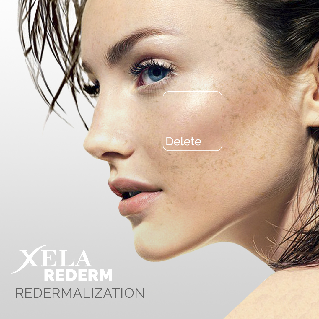 Xela Rederm