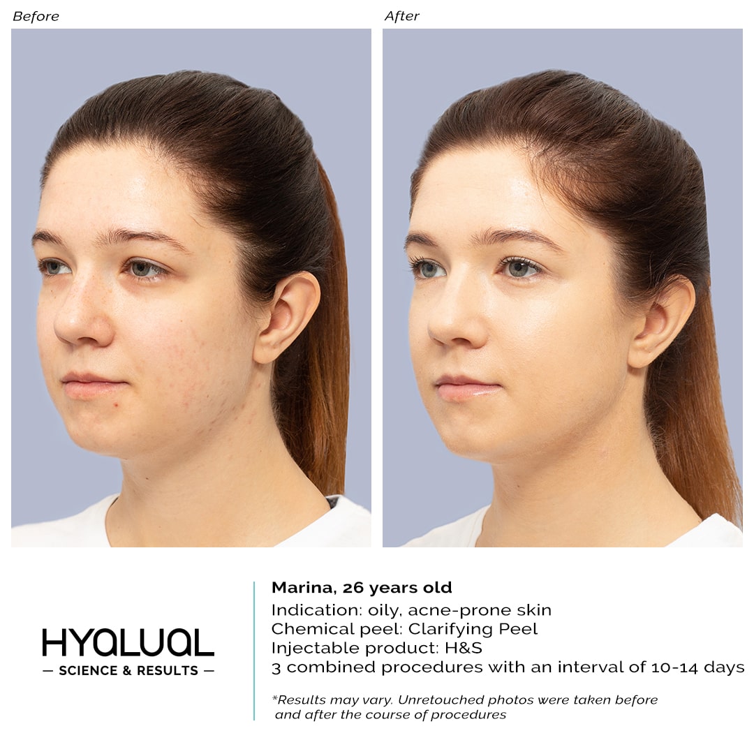 H&S + Clarifying Peel