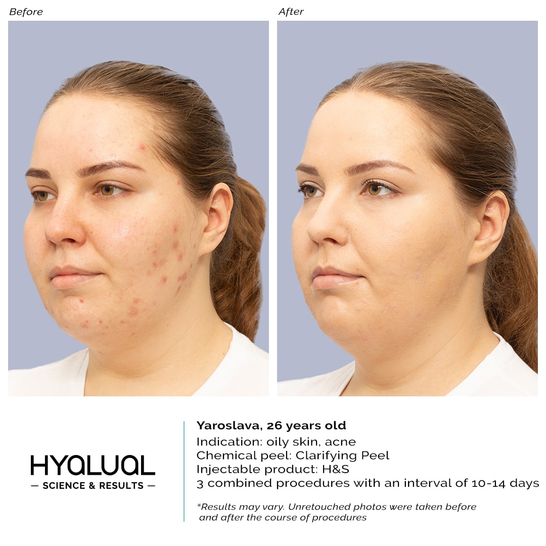 H&S + Clarifying Peel