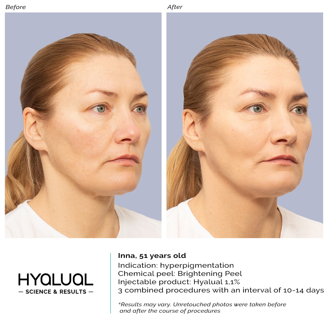 Hyalual 1,1% + Brightening Peel