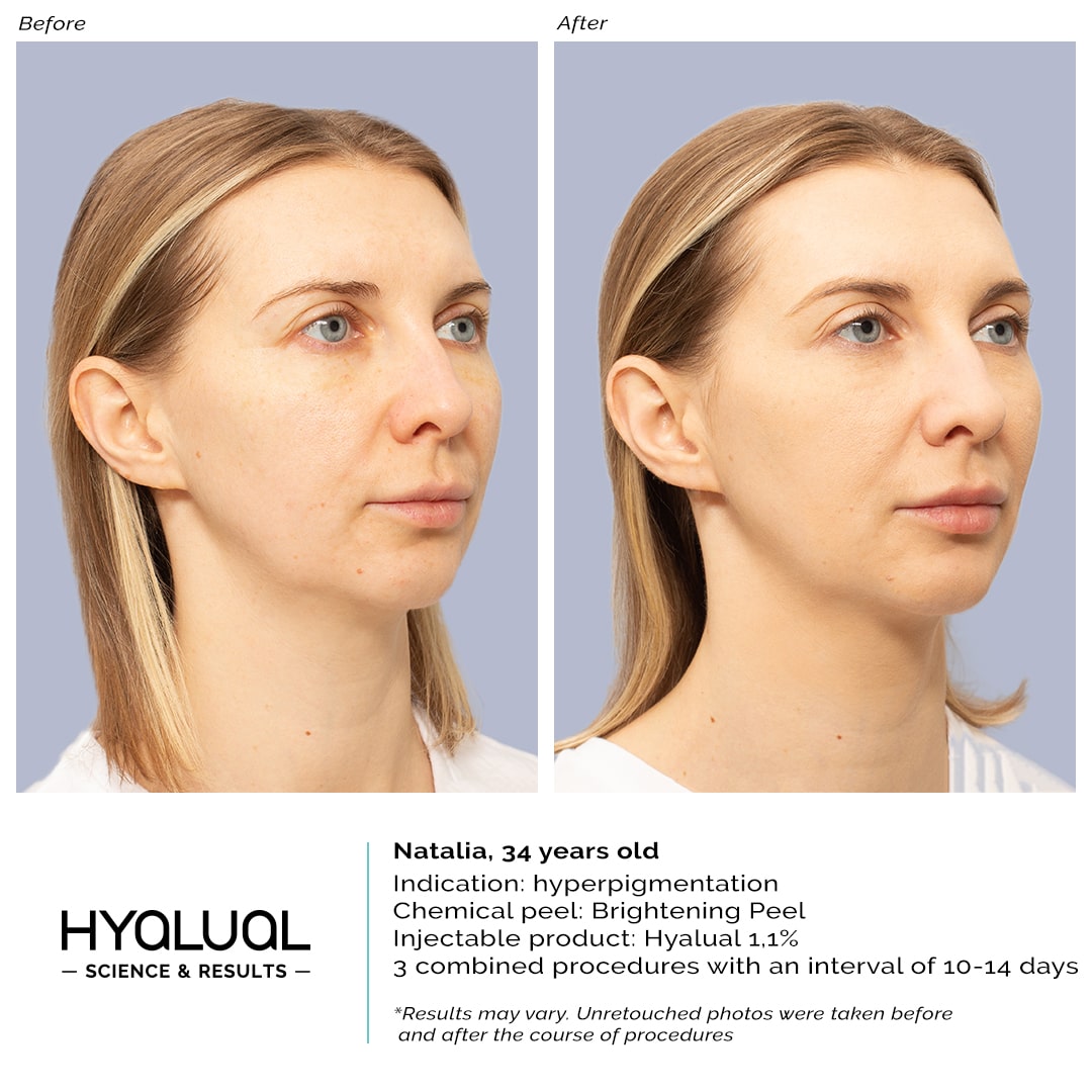 Hyalual 1,1% + Brightening Peel