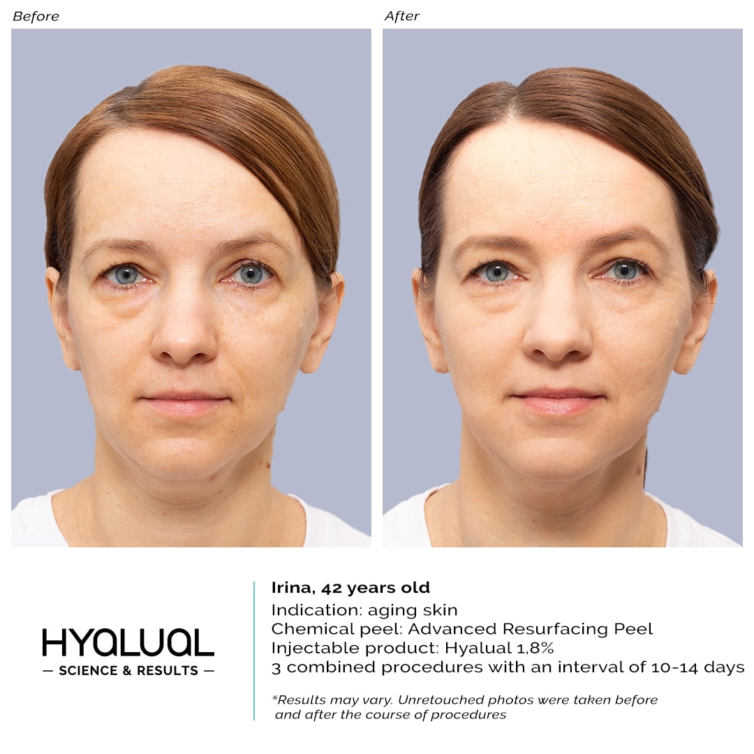 Hyalual 1,8% + Advanced Resurfacing...