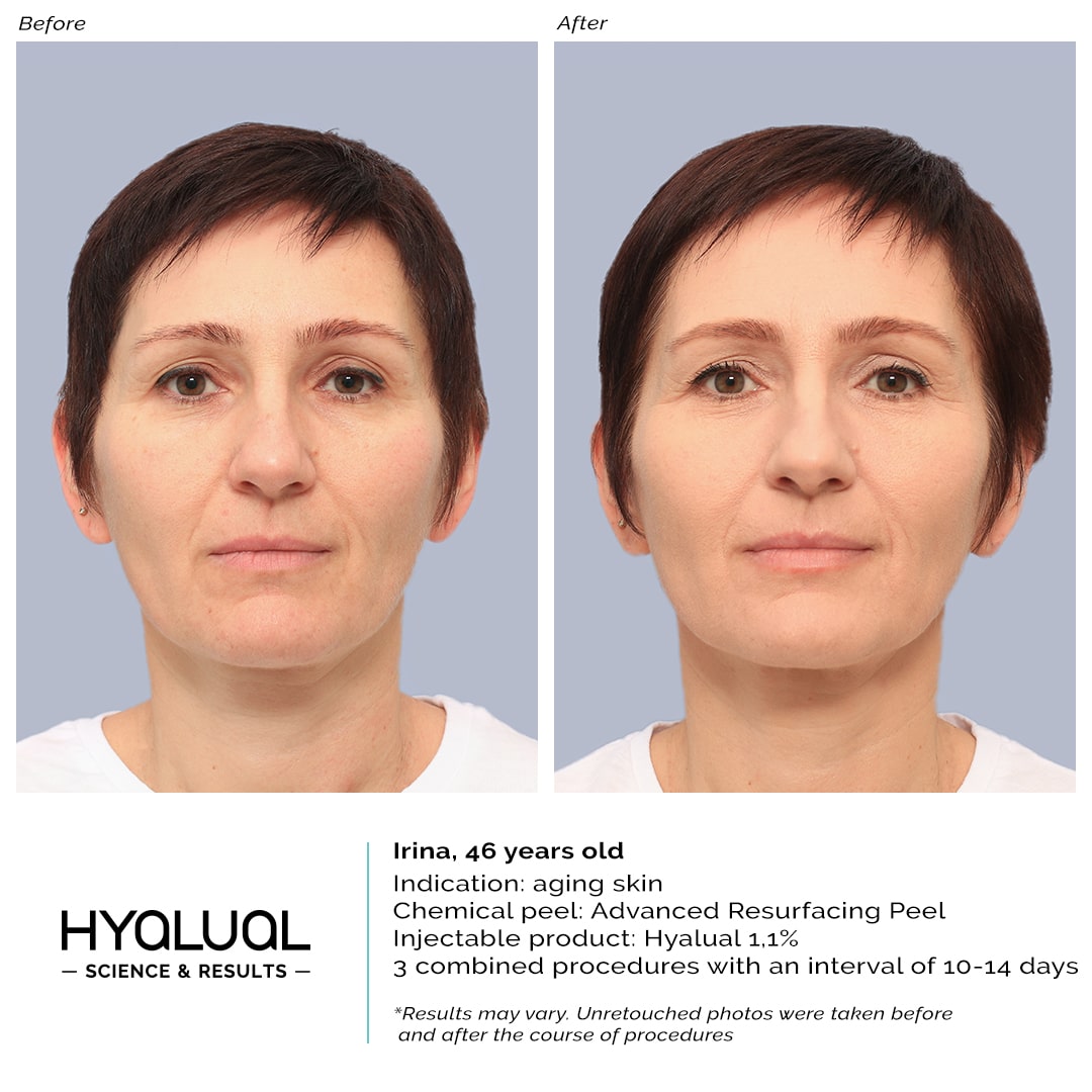 Hyalual 1,1% + Advanced Resurfacing...