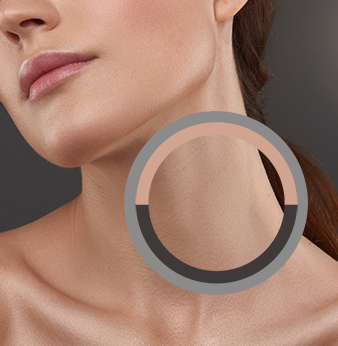 The neck as a challenge area for the Beautician: injectional Photoshop for Venus rings